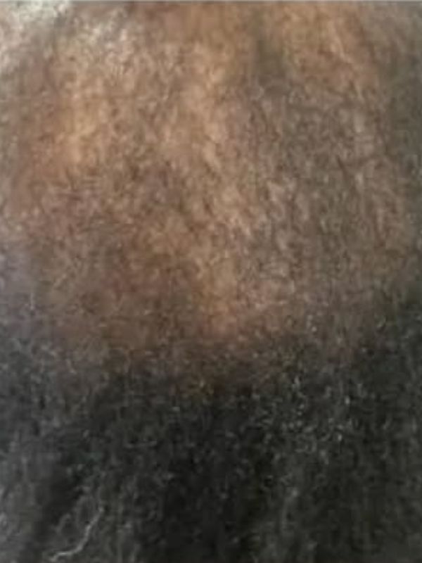 After — Scalp restoration results